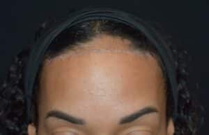 shock hair loss (telogen effluvium) after hairline lowering surgery